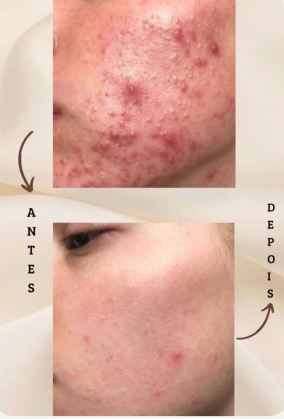 Antes e depois do tratamento de pele - Pense S.A.