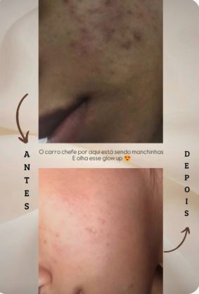 Antes e depois do tratamento de pele - Carla Dias