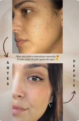Antes e depois do tratamento de pele - Rimberio