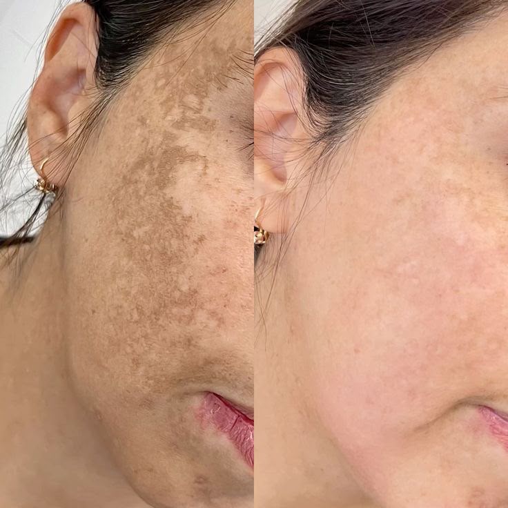 Antes e depois do tratamento de pele - Olivia