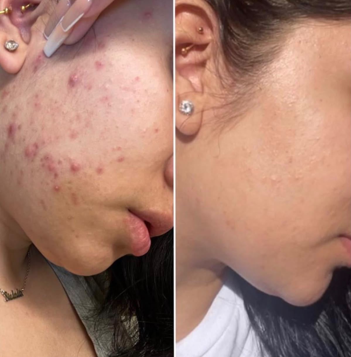 Antes e depois do tratamento de pele - Lorena