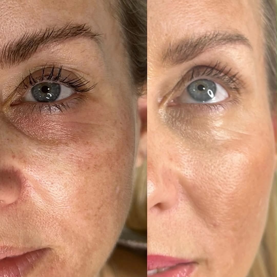 Antes e depois do tratamento de pele - Carla Dias